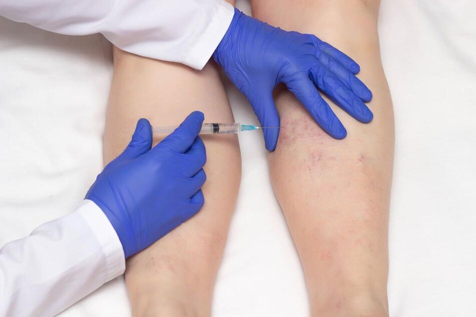 A escleroterapia é un método para tratar as varices