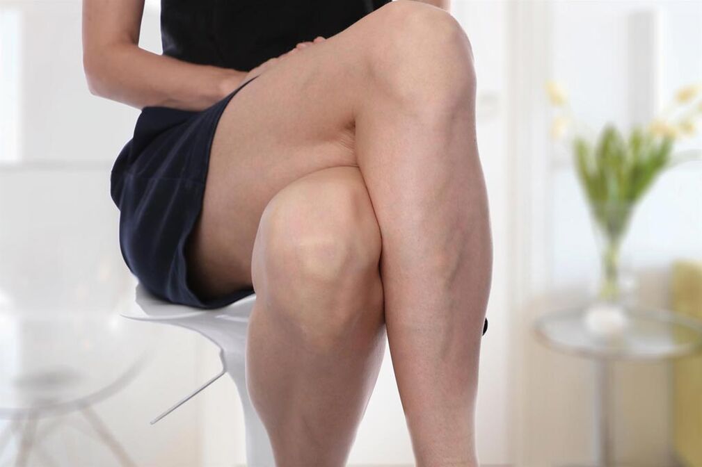 Varices nunha muller