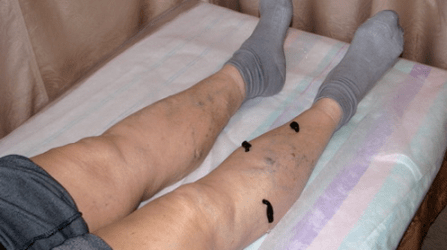 Tratar varices con sanguijuelas