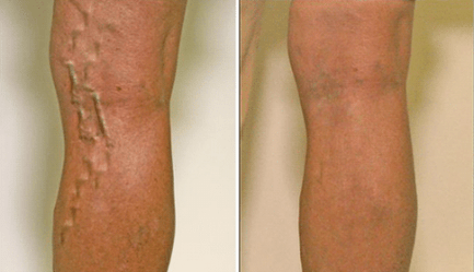 Varices nas 1a e 3a etapa de desenvolvemento