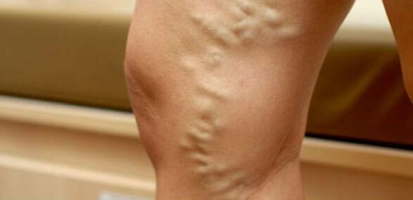 Varices nas pernas das mulleres