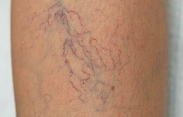 Varices nas pernas nas mulleres