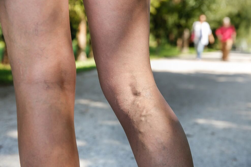 Varices nas pernas