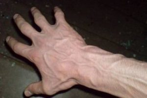 Métodos de tratamento de varices nas mans