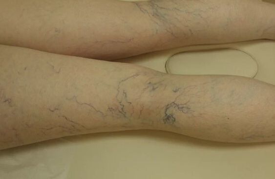 Estrelas de calambres nas pernas