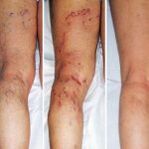 Varices das pernas