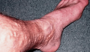 Causas de varices nas pernas nos homes