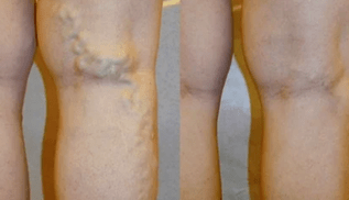 Signos e síntomas de varices nas pernas en homes