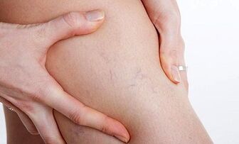Razóns para o desenvolvemento de varices nas pernas