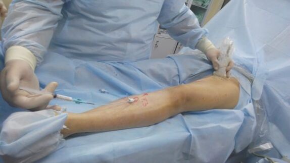 Cirurxía de varices nas pernas