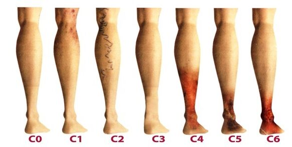 Fases do desenvolvemento de varices nas pernas