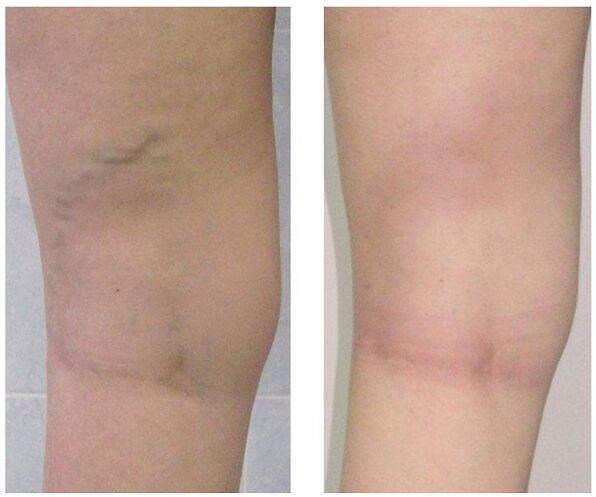 Vea das pernas antes e despois do tratamento de varices