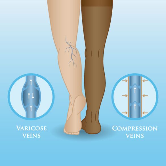 Efectos das prendas de compresión sobre as varices nas pernas