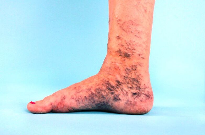 neglixencia de varices na perna
