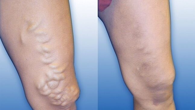 Pernas antes e despois do tratamento de varices severas