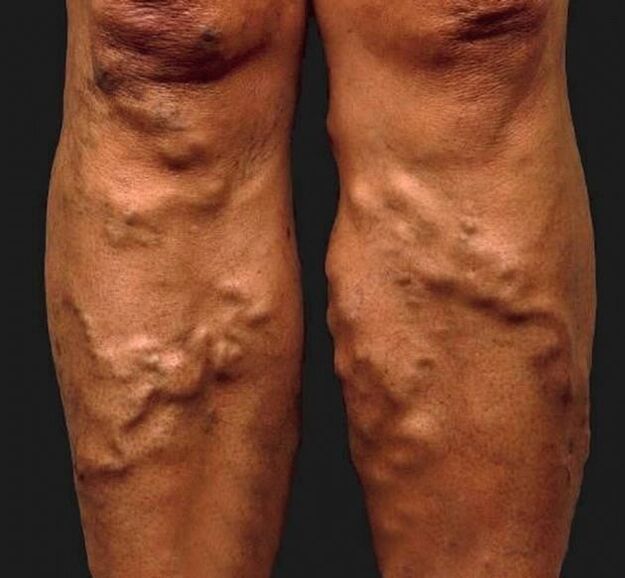 veas varicosas descoidadas nas pernas