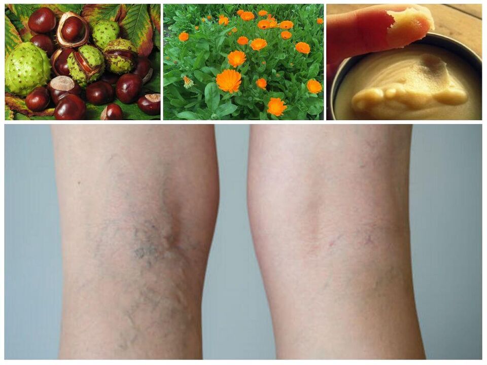 Varices nas pernas e remedios populares para a prevención