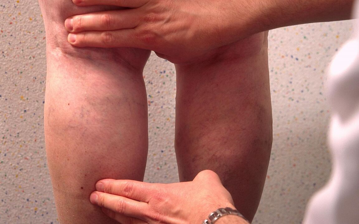 o médico examina as pernas con varices