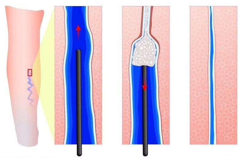 Esclerosización de varices nas pernas nos homes